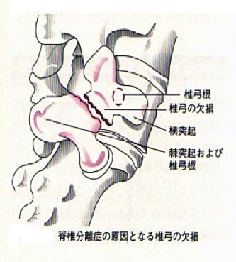 腰椎分離症